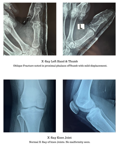 X-Ray Left Hand & Thumb-2